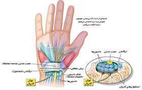 سندروم تونل کارپ (CTS)